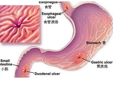 胃溃疡吃角瓜,天然食疗的养胃之道